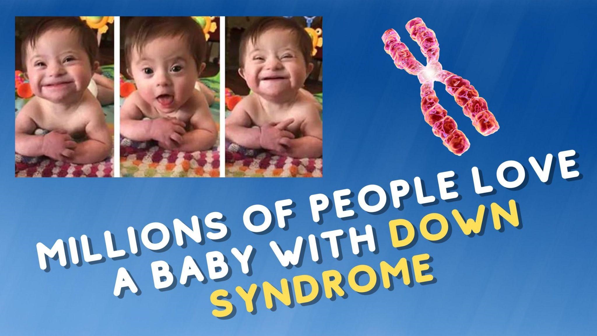 Millions Of People Love A Baby With Down Syndrome Act Biggy
